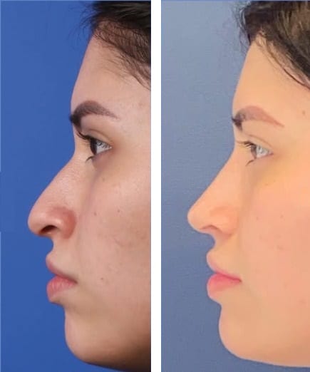 Rinoplastia caso 15 — antes y después